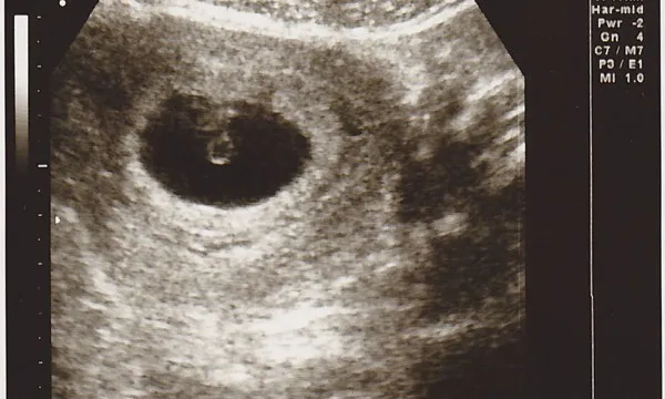 We're Having A Baby...!